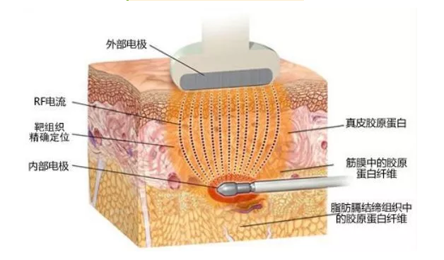 同时,她擅长的射频面部年轻化技术以高水平,高质量的美容